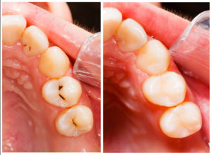 Composite Fillings - North Stapley Dental Care