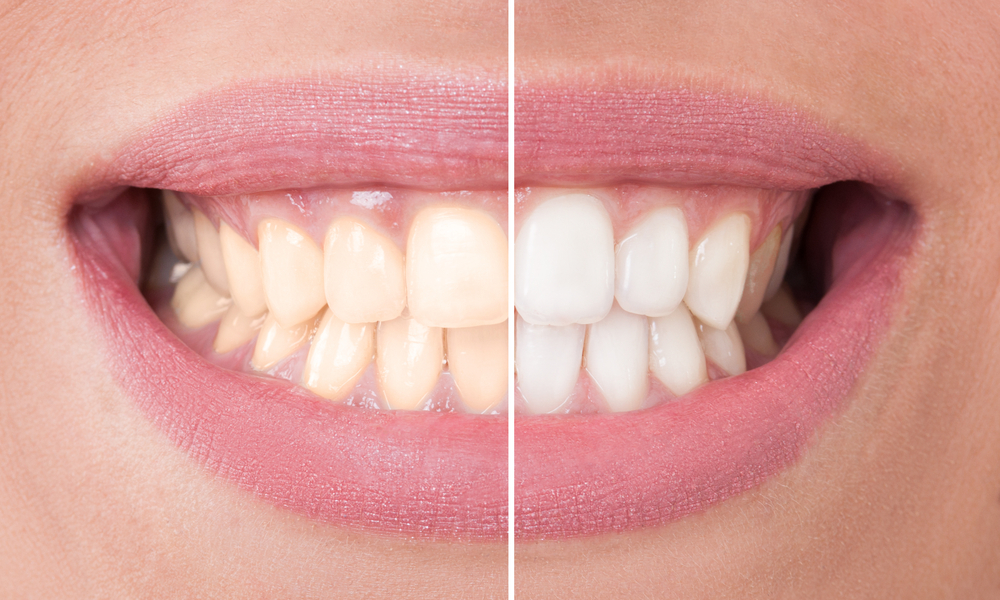 Teeth Whitening -North Stapley Dental Care
