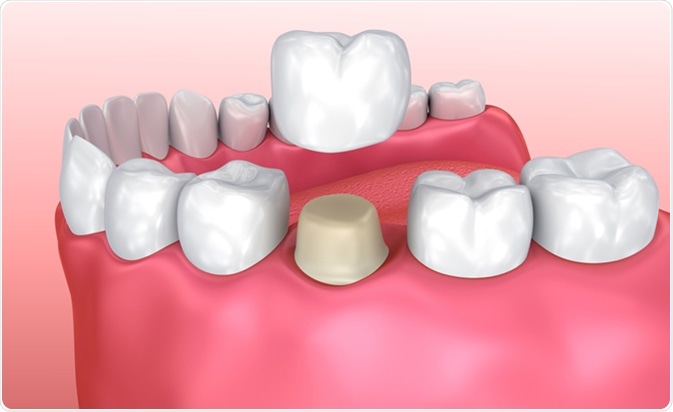 Dental Crowns In North Stapley Dental Care