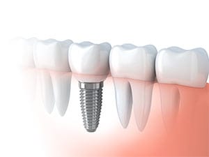 Dental Implants in North Stapley Dental Care