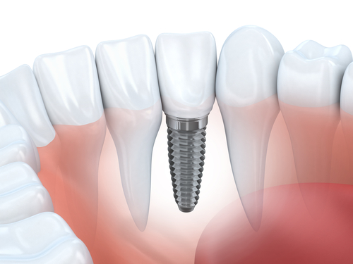 Dental Implants in Mesa