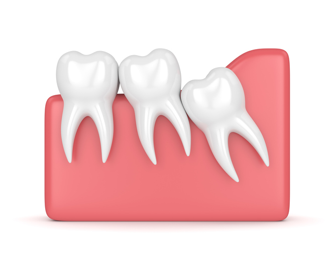 Wisdom Teeth Extractions in North Stapley Dental Care