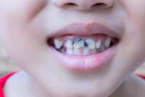 Baby Bottle Tooth Decay - North Stapley Dental Care