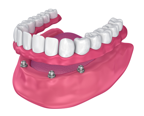Implant Supported Dentures - North Stapley Dental Care