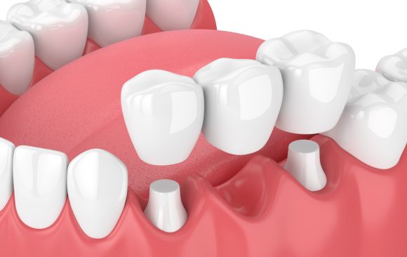 Dental Bridges in North Stapley Dental Care