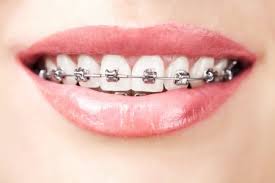 Braces - North Stapley Dental Care