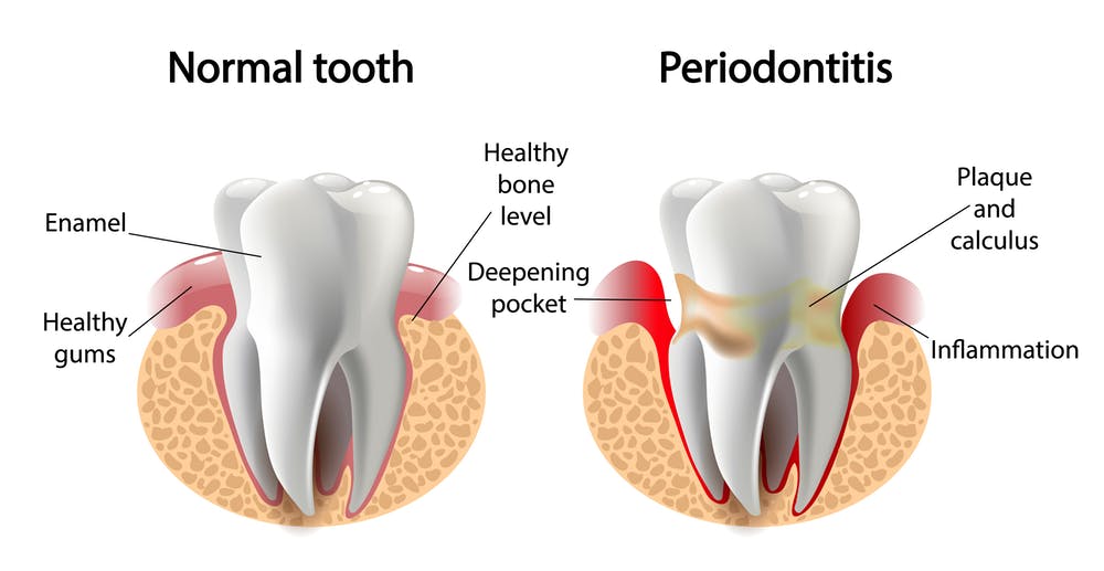 What Is Periodontal Disease?