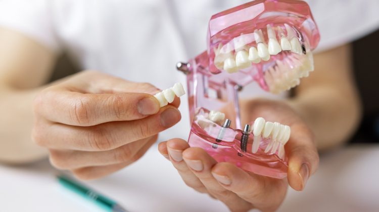 denture implant